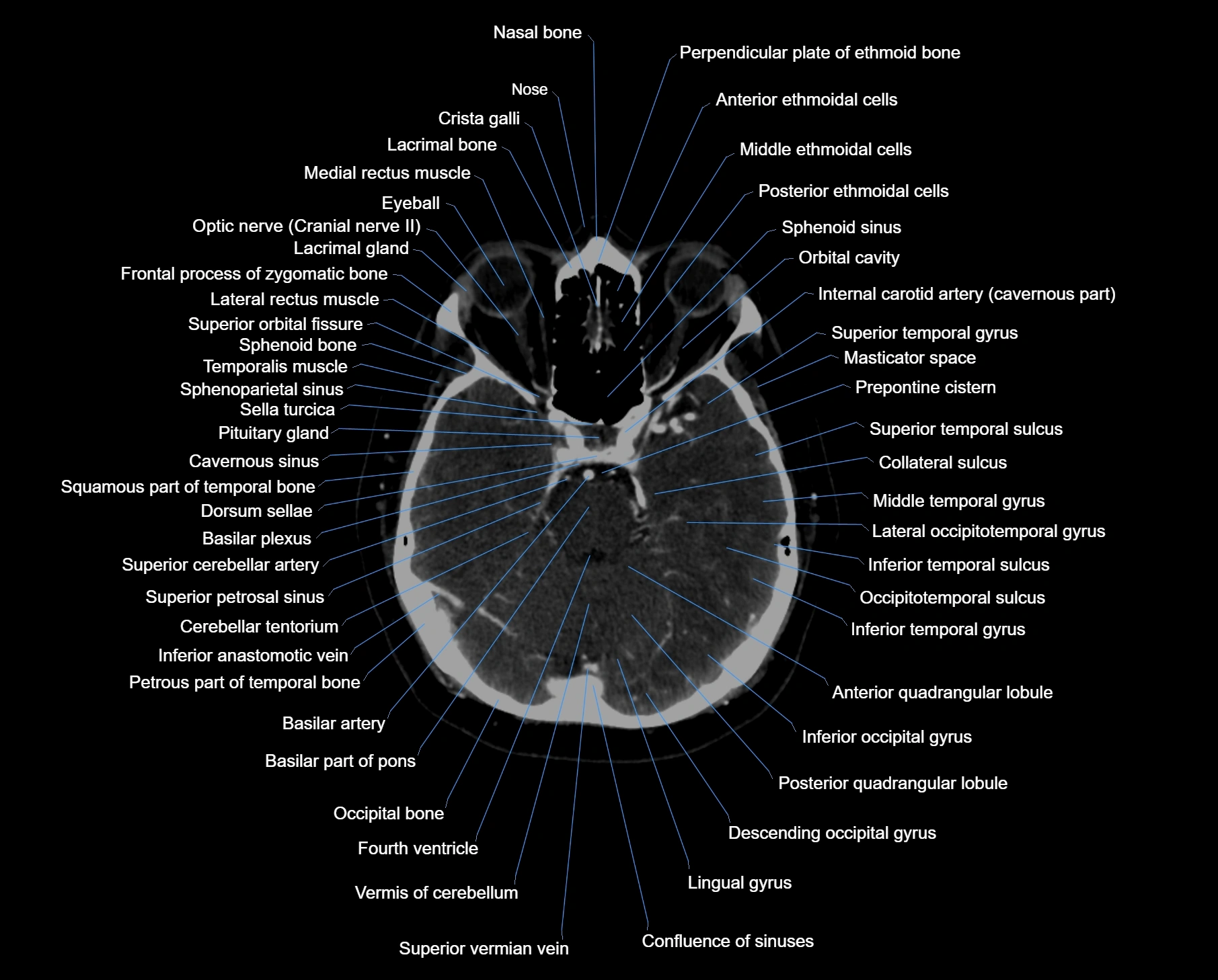 CT scan brain axial labelled cross sectional anatomy image-img-000023.webp